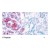 Figure 1. Immunohistochemical analysis of paraffin-embedded human breast carcinoma tissue using STAT4 (phospho-Tyr693) antibody AP02346PU.