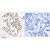 Figure 1. Immunohistochemical analysis of paraffin-embedded human breast carcinoma tissue using ATM (phospho-Ser1981) antibody (AP02410PU-N and AP024PU-S.