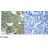 Figure 1. Immunohistochemical analysis of paraffin-embedded human breast carcinoma tissue using MEK1 (phospho-Ser221) antibody AP02443PU