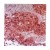 Figure 1. Immunoperoxidase staining of formalin-fixed paraffin embedded human lung cancer tissue showing cytoplasmic localization of dihydrodiol dehydrogenase.