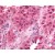 Lung small cell carcinoma: Formalin-Fixed Paraffin-Embedded (FFPE)