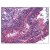 AP07834PU-N APC1 antibody staining of Formalin-Fixed Paraffin-Embedded Human Pancreatic Carcinoma at 10 µg/ml followed by biotinylated Goat anti-Rabbit IgG secondary antibody, alkaline phosphatase-streptavidin and chromogen.
