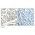 Figure 1. Immunohistochemical analysis of paraffin-embedded human breast carcinoma tissue using using ABL1/2 antibody Phospho-Tyr393/429  (#AP08038PU).