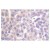Immunohistochemistry analyzes of c-PLA2 antibody (Cat.-No.: AP06422PU-N) in paraffin-embedded human colon carcinoma tissue.