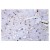 Immunohistochemistry (IHC) analyzes of AKAP13 antibody (Cat.-No. AP01177PU-N) in paraffin-embedded human lung carcinoma tissue.