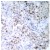 Immunohistochemistry (IHC) analysis of p53 pSer6 antibody (Cat.-No.: AP01660PU-N) in paraffin-embedded human breast carcinoma tissue.