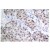Immunohistochemistry (IHC) analysis of p53 (pSer315) antibody (Cat.-No.: AP01657PU-N) in paraffin-embedded human breast carcinoma tissue.