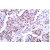 Immunohistochemistry (IHC) analysis of p53 pSer15 antibody (Cat.-No.: AP01656PU-N) in paraffin-embedded human breast carcinoma tissue.