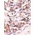 Formalin-fixed and paraffin-embedded human cancer tissue reacted with the primary antibody, which was peroxidase-conjugated to the secondary antibody, followed by AEC staining