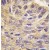 Formalin-fixed and paraffin-embedded human lung carcinoma tissue reacted with MEG2 antibody (C-term), which was peroxidase-conjugated to the secondary antibody, followed by DAB staining.