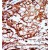 Formalin-fixed and paraffin-embedded human cancer tissue reacted with the primary antibody, which was peroxidase-conjugated to the secondary antibody, followed by AEC staining.