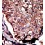 Formalin-fixed and paraffin-embedded human cancer tissue reacted with the primary antibody, which was peroxidase-conjugated to the secondary antibody, followed by DAB staining.