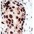 Figure 2. Formalin-fixed and paraffin-embedded human cancer tissue reacted with the primary antibody, which was peroxidase-conjugated to the secondary antibody, followed by DAB staining. This data demonstrates the use of this antibody for immunohistochemistry; clinical relevance has not been evaluated.