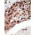 Figure 2. AP11177PU-N SET9 antibody staining of Formalin-Fixed and Paraffin-Embedded Human cancer tissue. The primary antibody was peroxidase-conjugated to the secondary antibody, followed by DAB staining.
This data demonstrates the use of this antibody for immunohistochemistry; clinical relevance has not been evaluated.