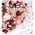 Formalin-fixed and paraffin-embedded human cancer tissue reacted with the primary antibody, which was peroxidase-conjugated to the secondary antibody, followed by AEC staining. This data demonstrates the use of this antibody for immunohistochemistry; clinical relevance has not been evaluated.