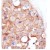 Formalin-fixed and paraffin-embedded human cancer tissue reacted with the primary antibody, which was peroxidase-conjugated to the secondary antibody, followed by DAB staining. This data demonstrates the use of this antibody for immunohistochemistry; clinical relevance has not been evaluated.