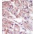 Formalin-fixed and paraffin-embedded human cancer tissue reacted with the primary antibody, which was peroxidase-conjugated to the secondary antibody, followed by AEC staining.