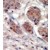Formalin-fixed and paraffin-embedded human cancer tissue reacted with the primary antibody, which was peroxidase-conjugated to the secondary antibody, followed by DAB staining
