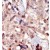 Formalin-fixed and paraffin-embedded human cancer tissue reacted with the primary antibody, which was peroxidase-conjugated to the secondary antibody, followed by DAB staining.