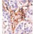Formalin-fixed and paraffin-embedded human cancer tissue reacted with the primary antibody, which was peroxidase-conjugated to the secondary antibody, followed by AEC staining. This data demonstrates the use of this antibody for immunohistochemistry; clinical relevance has not been evaluated.