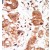 Formalin-fixed and paraffin-embedded human cancer tissue reacted with the primary antibody, which was peroxidase-conjugated to the secondary antibody, followed by DAB staining.