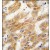 Formalin-fixed and paraffin-embedded human hepatocarcinoma tissue reacted with ALDH4A1 antibody (C-term), which was peroxidase-conjugated to the secondary antibody, followed by DAB staining.