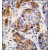 Formalin-fixed and paraffin-embedded human hepatocarcinoma tissue reacted with ALDH4A1 antibody (Center), which was peroxidase-conjugated to the secondary antibody, followed by DAB staining.