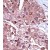 Formalin-fixed and paraffin-embedded human cancer tissue reacted with the primary antibody, which was peroxidase-conjugated to the secondary antibody, followed by DAB staining.