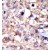 Formalin-fixed and paraffin-embedded human cancer tissue reacted with the primary antibody, which was peroxidase-conjugated to the secondary antibody, followed by AEC staining.