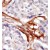Formalin-fixed and paraffin-embedded human cancer tissue reacted with the primary antibody, which was peroxidase-conjugated to the secondary antibody, followed by AEC staining.