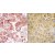 (LEFT)Formalin-fixed and paraffin-embedded human cancer tissue reacted with the primary antibody, which was peroxidase-conjugated to the secondary antibody, followed by AEC staining. (RIGHT)Formalin-fixed and paraffin-embedded human hepatocarcinoma tissue reacted with GRK7 Antibody (C-term), which was peroxidase-conjugated to the secondary antibody, followed by DAB staining.