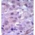 Formalin-fixed and paraffin-embedded human cancer tissue reacted with the primary antibody, which was peroxidase-conjugated to the secondary antibody, followed by AEC staining.