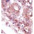 Formalin-fixed and paraffin-embedded human cancer tissue reacted with the primary antibody, which was peroxidase-conjugated to the secondary antibody, followed by DAB staining.