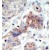 Formalin-fixed and paraffin-embedded human cancer tissue reacted with the primary antibody, which was peroxidase-conjugated to the secondary antibody, followed by DAB staining.
