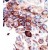 Formalin-fixed and paraffin-embedded human cancer tissue reacted with the primary antibody, which was peroxidase-conjugated to the secondary antibody, followed by DAB staining.