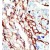 Formalin-fixed and paraffin-embedded human cancer tissue reacted with the primary antibody, which was peroxidase-conjugated to the secondary antibody, followed by AEC staining.