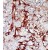 Formalin-fixed and paraffin-embedded human cancer tissue reacted with the primary antibody, which was peroxidase-conjugated to the secondary antibody, followed by DAB staining.