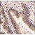Formalin-fixed and paraffin-embedded human lung carcinoma tissue reacted with ERK4 antibody (C-term), which was peroxidase-conjugated to the secondary antibody, followed by DAB staining.