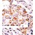 Formalin-fixed and paraffin-embedded human cancer tissue reacted with the primary antibody, which was peroxidase-conjugated to the secondary antibody, followed by DAB staining.