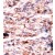 Formalin-fixed and paraffin-embedded human cancer tissue reacted with the primary antibody, which was peroxidase-conjugated to the secondary antibody, followed by AEC staining.