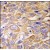 Formalin-fixed and paraffin-embedded human lung carcinoma tissue reacted with DDIT4 antibody (N-term), which was peroxidase-conjugated to the secondary antibody, followed by DAB staining.