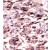 Formalin-fixed and paraffin-embedded human cancer tissue reacted with the primary antibody, which was peroxidase-conjugated to the secondary antibody, followed by AEC staining. This data demonstrates the use of this antibody for immunohistochemistry; clinical relevance has not been evaluated.
