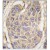 Formalin-fixed and paraffin-embedded human lung carcinoma tissue reacted with B2M antibody (C-term) (Cat.#AP12415PU-N), which was peroxidase-conjugated to the secondary antibody, followed by DAB staining. This data demonstrates the use of this antibody for immunohistochemistry; clinical relevance has not been evaluated.