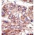 Formalin-fixed and paraffin-embedded human cancer tissue reacted with the primary antibody, which was peroxidase-conjugated to the secondary antibody, followed by AEC staining. This data demonstrates the use of this antibody for immunohistochemistry; clinical relevance has not been evaluated.