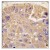 Formalin-fixed and paraffin-embedded human hepatocarcinoma tissue reacted with METAP2 antibody (C-term) (Cat#AP12163PU-N), which was peroxidase-conjugated to the secondary antibody, followed by DAB staining. This data demonstrates the use of this antibody for immunohistochemistry; clinical relevance has not been evaluated.