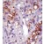 Formalin-fixed and paraffin-embedded human cancer tissue reacted with the primary antibody, which was peroxidase-conjugated to the secondary antibody, followed by DAB staining. This data demonstrates the use of this antibody for immunohistochemistry; clinical relevance has not been evaluated.