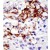 Formalin-fixed and paraffin-embedded human cancer tissue reacted with the primary antibody, which was peroxidase-conjugated to the secondary antibody, followed by DAB staining. This data demonstrates the use of this antibody for immunohistochemistry; clinical relevance has not been evaluated.