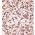 Formalin-fixed and paraffin-embedded human cancer tissue reacted with the primary antibody, which was peroxidase-conjugated to the secondary antibody, followed by AEC staining.