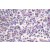 Immunohistochemistry analysis of B-Raf Antibody (Cat.-No AP06500PU-N) in paraffin-embedded Human breast carcinoma tissue.