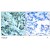 Immunohistochemical analysis of paraffin-embedded human lung carcinoma tissue, using MEK1/MEK2 Antibody (#AP02714PU).
